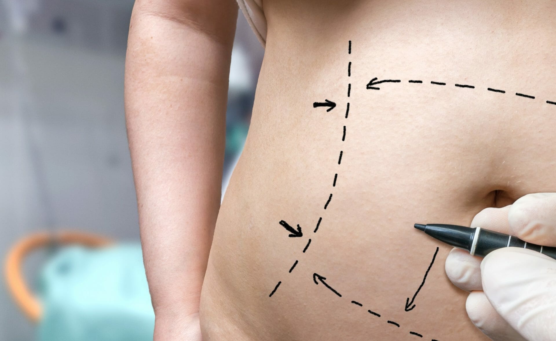 Is a tummy tuck right for me? | Bristol Plastic Surgery